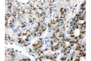 Catalase was detected in paraffin-embedded sections of human liver cancer tissues using rabbit anti- Catalase Antigen Affinity purified polyclonal antibody (Catalog # ) at 1 µg/mL. (Catalase Antikörper  (AA 344-527))