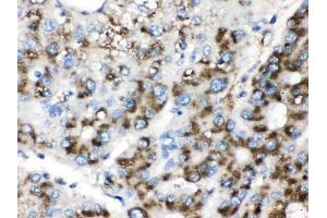 Catalase was detected in paraffin-embedded sections of human liver cancer tissues using rabbit anti- Catalase Antigen Affinity purified polyclonal antibody (Catalog # ) at 1 µg/mL.