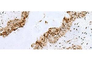 Immunohistochemistry of paraffin-embedded Human breast cancer tissue using H2AFJ Polyclonal Antibody at dilution of 1:170(x200) (H2AFJ Antikörper)