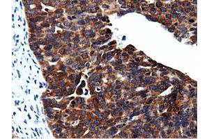Immunohistochemical staining of paraffin-embedded Adenocarcinoma of Human colon tissue using anti-CBWD1 mouse monoclonal antibody. (CBWD1 Antikörper)