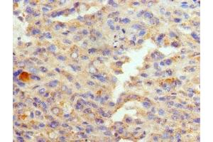 Immunohistochemistry of paraffin-embedded human melanoma using ABIN7152009 at dilution of 1:100 (GATA1 Antikörper  (AA 39-153))