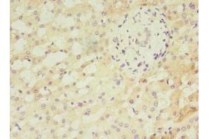 Immunohistochemistry of paraffin-embedded human liver cancer using ABIN7144167 at dilution of 1:100 (ANKMY2 Antikörper  (AA 1-280))