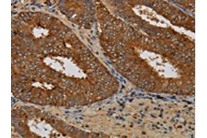 The image on the left is immunohistochemistry of paraffin-embedded Human colon cancer tissue using ABIN7129963(KCNK17 Antibody) at dilution 1/60, on the right is treated with fusion protein. (KCNK17 Antikörper)