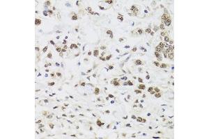 Immunohistochemistry of paraffin-embedded human gastric cancer using PPP1CC antibody (ABIN5972199) at dilution of 1/100 (40x lens). (PPP1CC Antikörper)