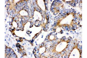Anti- IDH2 Picoband antibody, IHC(P) IHC(P): Human Intestinal Cancer Tissue