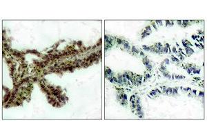 Immunohistochemistry (IHC) image for anti-V-Akt Murine Thymoma Viral Oncogene Homolog 1 (AKT1) (pThr308) antibody (ABIN1847449) (AKT1 Antikörper  (pThr308))