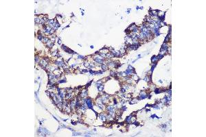 Immunohistochemistry of paraffin-embedded Human colon carcinoma using  Rabbit pAb (ABIN7265426) at dilution of 1:100 (40x lens). (ACSS1 Antikörper  (AA 340-689))