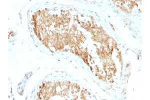 Formalin-fixed, paraffin-embedded human Testicular Carcinoma stained with ALDH1A1 Mouse Monoclonal Antibody (ALDH1A1/1381). (ALDH1A1 Antikörper  (AA 315-434))