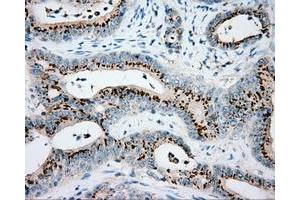 Immunohistochemical staining of paraffin-embedded Adenocarcinoma of colon tissue using anti-VAT1L mouse monoclonal antibody.