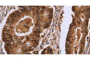 Immunohistochemistry of paraffin-embedded Human colon cancer tissue using EXTL3 Polyclonal Antibody at dilution 1:30 (EXTL3 Antikörper)