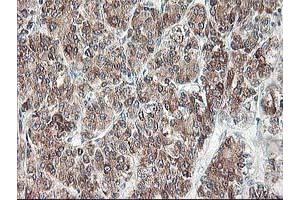 Immunohistochemical staining of paraffin-embedded Carcinoma of Human liver tissue using anti-RPN1 mouse monoclonal antibody. (RPN1 Antikörper)