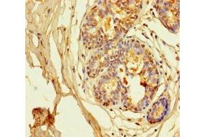Immunohistochemistry of paraffin-embedded human breast cancer using ABIN7163953 at dilution of 1:100 (Kv1.6/KCNA6 Antikörper  (AA 1-171))
