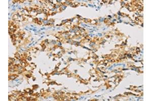 The image on the left is immunohistochemistry of paraffin-embedded Human thyroid cancer tissue using ABIN7129804(IDH3B Antibody) at dilution 1/30, on the right is treated with fusion protein.
