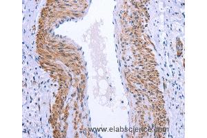 Immunohistochemistry of Human cervical cancer using GPR171 Polyclonal Antibody at dilution of 1:25 (GPR171 Antikörper)
