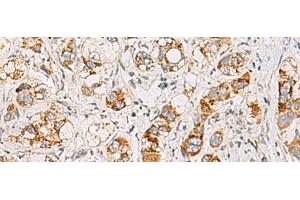 Immunohistochemistry of paraffin-embedded Human liver cancer tissue using MMAB Polyclonal Antibody at dilution of 1:65(x200) (MMAB Antikörper)