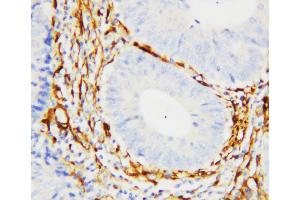 Anti-Galectin 1 antibody, IHC(P) IHC(P): Human Intestinal Cancer Tissue (LGALS1/Galectin 1 Antikörper  (C-Term))