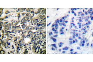 P-peptide - +Immunohistochemical analysis of paraffin-embedded human breast carcinoma tissue using 14-3-3 ζ (phospho-Ser58) antibody. (14-3-3 zeta Antikörper  (pSer58))