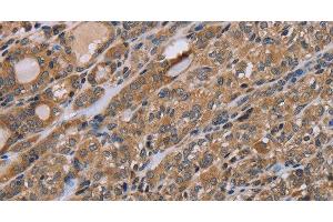 Immunohistochemistry of paraffin-embedded Human thyroid cancer tissue using NAA25 Polyclonal Antibody at dilution 1:40 (NAA25 Antikörper)