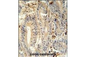 MEP1A antibody (N-term) (ABIN652039 and ABIN2840513) immunohistochemistry analysis in formalin fixed and paraffin embedded human colon carcinoma followed by peroxidase conjugation of the secondary antibody and DAB staining. (MEP1A Antikörper  (N-Term))