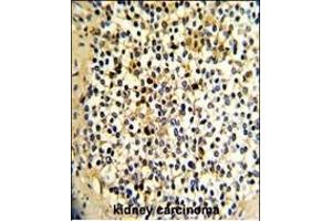 Formalin-fixed and paraffin-embedded human kidney carcinoma with DCXR Antibody (Center), which was peroxidase-conjugated to the secondary antibody, followed by DAB staining. (DCXR Antikörper  (AA 79-106))