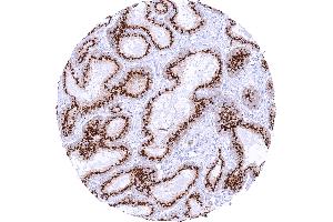 Prostatic adenocarcinoma Gleason 336 with strong granular perinuclear cytoplasmic prostein staining of tumor cells (Rekombinanter SLC45A3 Antikörper  (N-Term))