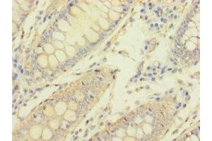 Immunohistochemistry of paraffin-embedded human colon cancer using ABIN7162103 at dilution of 1:100