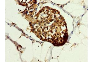 IHC image of ABIN7154867 diluted at 1:200 and staining in paraffin-embedded human breast cancer performed on a Leica BondTM system. (HSP70 1A Antikörper  (AA 418-512))