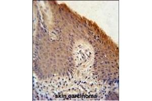 KRT1 Antibody (Center) (ABIN651241 and ABIN2840150) immunohistochemistry analysis in formalin fixed and paraffin embedded human skin carcinoma followed by peroxidase conjugation of the secondary antibody and DAB staining. (KRTAP1-1 Antikörper  (AA 88-117))
