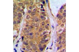 Immunohistochemical analysis of NF-kappaB p105 (pS927) staining in human breast cancer formalin fixed paraffin embedded tissue section. (NFKB1 Antikörper  (C-Term, pSer927))