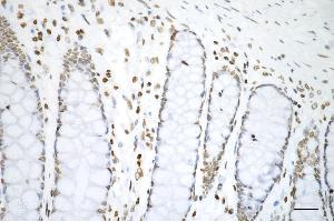 Immunohistochemistry was performed on paraffin-embedded human sigmoid colon carcinoma using histone H3 (di methyl K4) antibody (ABIN7798955), 1:200). (Rekombinanter Histone 3 Antikörper  (H3K4me2))