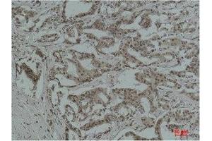 Immunohistochemical analysis of paraffin-embedded Human Breast Carcinoma using Acetyl Lysine Monoclonal Antibody. (Acetylated Lysine Antikörper)