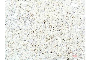 Immunohistochemical analysis of paraffin-embedded Human Breast Carcinoma Tissue using JAK1 Mouse mAb diluted at 1:200. (JAK1 Antikörper  (AA 960-1040))