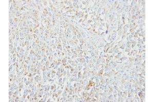 IHC-P Image Immunohistochemical analysis of paraffin-embedded CL1-5 xenograft, using MIPEP, antibody at 1:100 dilution. (MIPEP Antikörper)