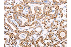 The image on the left is immunohistochemistry of paraffin-embedded Human thyroid cancer tissue using ABIN7128594(ATPIF1 Antibody) at dilution 1/50, on the right is treated with fusion protein. (ATPase Inhibitory Factor 1 Antikörper)