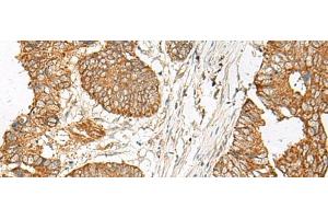 Immunohistochemistry of paraffin-embedded Human colorectal cancer tissue using GNAT1 Polyclonal Antibody at dilution of 1:25(x200) (GNAT1 Antikörper)