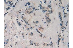 Detection of aZGP1 in Human Breast Cancer Tissue using Polyclonal Antibody to Alpha-2-Glycoprotein 1, Zinc Binding (aZGP1) (AZGP1 Antikörper  (AA 180-298))