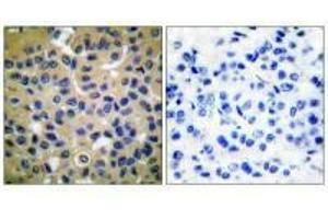 Immunohistochemical analysis of paraffin-embedded human breast carcinoma tissue using Collagen II antibody. (COL2A1 Antikörper)