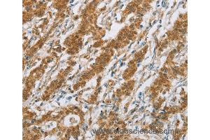 Immunohistochemistry of Human gastric cancer using CYP2E1 Polyclonal Antibody at dilution of 1:30 (CYP2E1 Antikörper)