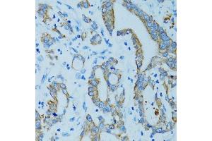 Immunohistochemistry of paraffin-embedded human colon carcinoma using KRT15 antibody. (KRT15 Antikörper)