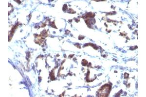 Formalin-fixed, paraffin-embedded human Gastric Carcinoma stained with ZFYVE28 Mouse Monoclonal Antibody (LST2/2426) (ZFYVE28 Antikörper)