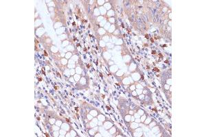 Immunohistochemistry of paraffin-embedded human colon using PI3 Kinase p85 beta antibody (ABIN7269320) at dilution of 1:200 (40x lens). (PIK3R2 Antikörper)
