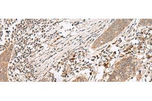 Immunohistochemistry of paraffin-embedded Human esophagus cancer tissue using FUT10 Polyclonal Antibody at dilution of 1:45(x200)