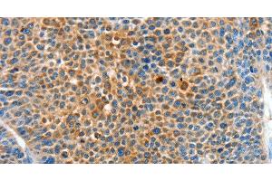 Immunohistochemistry of paraffin-embedded Human liver cancer tissue using SERPINF2 Polyclonal Antibody at dilution 1:50 (alpha 2 Antiplasmin Antikörper)