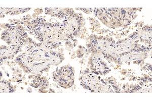 Detection of ACO1 in Human Lung cancer Tissue using Polyclonal Antibody to Aconitase 1 (ACO1) (Aconitase 1 Antikörper  (AA 251-443))