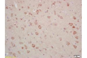 Formalin-fixed and paraffin embedded human gastric carcinoma labeled with Rabbit Anti Annexin A13 Polyclonal Antibody, Unconjugated (ABIN1714416) at 1:200 followed by conjugation to the secondary antibody and DAB staining (CRY1 Antikörper)