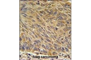 CD99L2 Antibody (Center) (ABIN651686 and ABIN2840361) immunohistochemistry analysis in formalin fixed and paraffin embedded human lung carcinoma followed by peroxidase conjugation of the secondary antibody and DAB staining. (CD99L2 Antikörper  (AA 39-66))