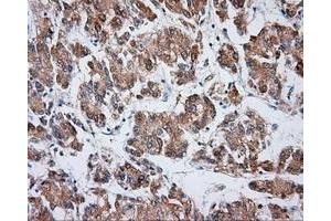 Immunohistochemical staining of paraffin-embedded Carcinoma of liver tissue using anti-VAT1L mouse monoclonal antibody.