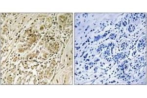 Immunohistochemistry analysis of paraffin-embedded human breast carcinoma, using IRS-1 (Phospho-Ser639) Antibody. (IRS1 Antikörper  (pSer639))