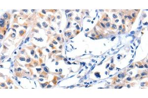 Immunohistochemistry of paraffin-embedded Human lung cancer tissue using Fibulin 5 Polyclonal Antibody at dilution 1:85 (Fibulin 5 Antikörper)