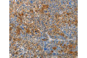 Immunohistochemistry of Human liver cancer using HTRA3 Polyclonal Antibody at dilution of 1:45 (HTRA3 Antikörper)